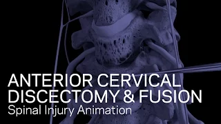 C5-6/C6-7 Anterior Cervical Discectomy with Fusion