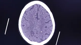 Evolution of a brain infarct