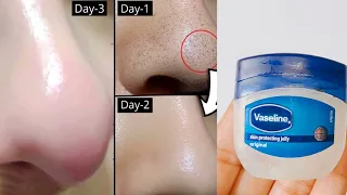 How to remove blackheads and Whiteheads from nose and face naturally at home