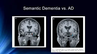 Neural Structures of Long Term Memory