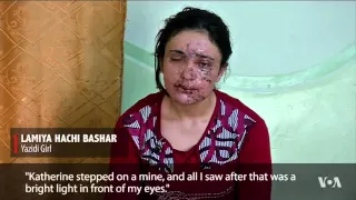 Yazidi Woman Traumatized by IS Seeks Aid for Disfigured Face