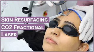 Fractional Laser Treatment | Skin Laser treatment | Fractional CO2 laser Skin Resurfacing Treatment