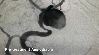 Giant aneurysm coiling and Flow diverter. Dr. Ahmad aoude. RAH.