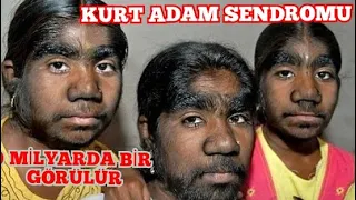 KURT ADAM SENDROMU ❗EVRİM GEÇİRMİŞ (HİPERTRİKOZ) SÜPER ve ilginç bilgiler