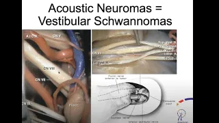 A Rare Brain Tumor Affecting Hearing & Balance - Acoustic Neuroma