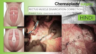 RECTUS MUSCLE DIVARICATION CORRECTION - (Tummy Tuck - Diastasis Recti) - Dr. Karthik Ram - HINDI