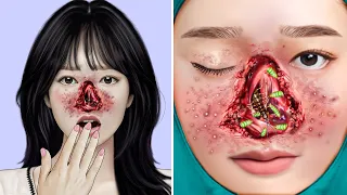 ASMR Necrotic Nose & Big Acne Removal | Deep Cleaning Animation