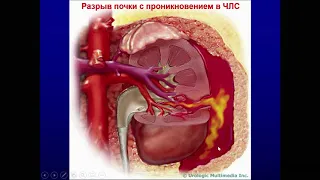 Травмы мочевыделительной системы лекция