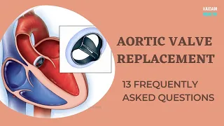 Aortic Valve Replacement- 13 Frequently Asked Questions