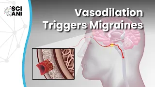 How does vasodilation trigger migraine in the trigeminovascular system?