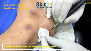 Dr Atul Jain Removing Wart via Electrocautery Method | Foot Wart Removal | Skinaa Clinic, Jaipur