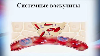 Системные васкулиты (Узелковый полиартериит, Чёрджа Стросса, Кавасаки, Гудпасчера, Вегенера)