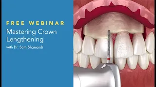 Dental Treatment: Functional Crown Lengthening May 10, 2021