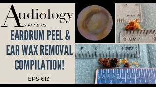 EARDRUM PEEL & EAR WAX REMOVAL COMPILATION - EP613