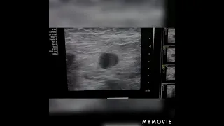 suspicious lymph node | ultrasound case