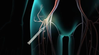 Catheter Ablation