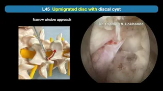 Full Endoscopic Lumbar Discectomy: Dr Pramod V  Lokhande