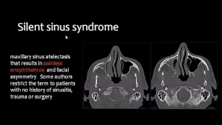 Sinonasal imaging   For non arab