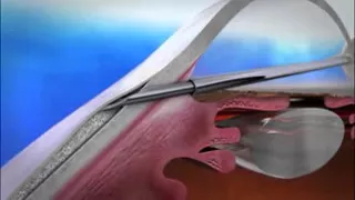 XEN glaucoma stent animation