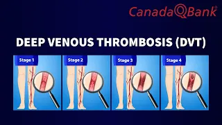 Deep Venous Thrombosis