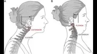 Craniocervical "tucking", a biomechanical fallacy and common cause of extracranial IJV stenosis