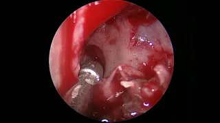 Orbit 1 Intraconal cavernous angioma EEA