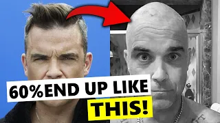 Hair Loss Always Defeats Transplant at The End!? Robbie Williams's Bad News