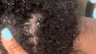 Scalp Scratching | Dandruff Removal | Big Flakes