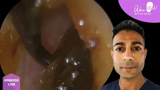 1,115 - Gigantic Stubborn Glue Ear Ear Wax Removal in 10 Year Old