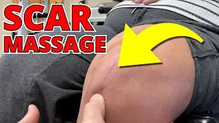 Scar Massage INCREDIBLE 8-Weeks After Knee Replacement