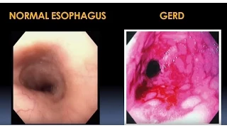 Diagnosis and Treatment for Esophageal and Motility Disorders Video - Brigham and Women's Hospital