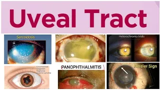 Uveal Tract 1 Major Topic: Uveitus and its Classification