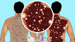 ASMR Treatment of Ticks & Maggots Infection From Back Neck | Severely Injured Animation | Satisfying