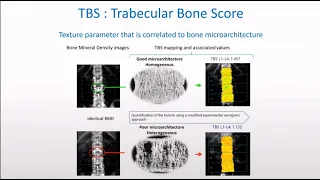 How to use TBS (Trabecular Bone Score) in combination with BMD in Clinical DXA practice.