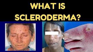 SYSTEMIC SCLEROSIS (SCLERODERMA) - What is Scleroderma? I Signs and symptoms of Scleroderma