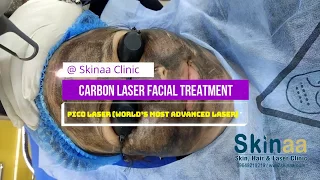 Carbon laser Facial & Peeling Treatment with Pico Laser at Skinaa Clinic, Jaipur