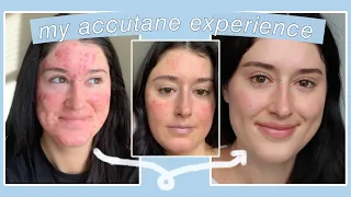 WHAT TO EXPECT WHILE TAKING ACCUTANE (isotretinoin)