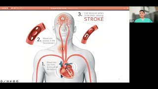 Brijesh Mehta on Stroke Training for EMS