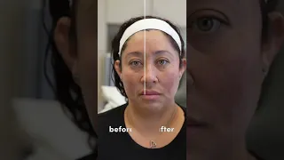 Watch how the newest NovaThread treatment lifts this patient's midface | La Jolla Cosmetic