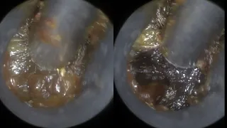 44 - Fully Occluding Ear Wax Removed using the WAXscope®️