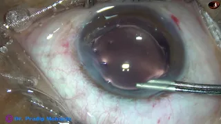 The "COVID CATARACT SYNDROME" : Pradip Mohanta, India, 15th September, 2020