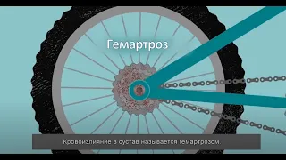 Что такое гемартроз