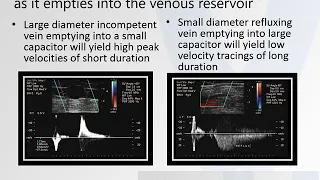 Vein diameter does NOT determine reflux time, size of varicosities DO!