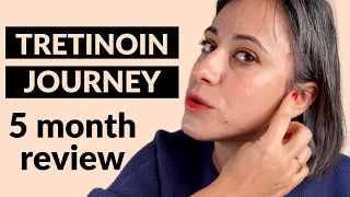 My tretinoin journey - 5 months review