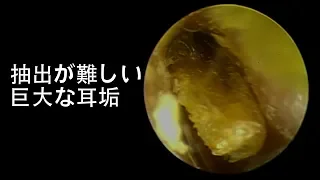 Relaxing Earwax Removal -- Huge Earwax That Is Hard To Extract