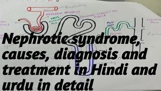 Nephrotic syndrome||symptoms||Causes||Diagnosis test||Treatment in Hindi||urdu