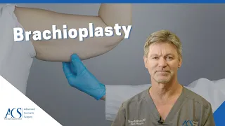 Brachioplasty Surgery Explained By Plastic Surgeon: What is it? Scars, Recovery and More!