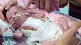 Baby Survives Surgery After Being Born With Heart Outside Chest