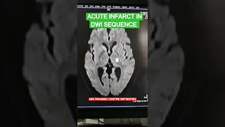 Acute Infarct in  Brain, Mri brain sequence pathology