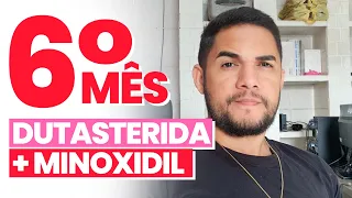 RESULTADO DO 6° MÊS | DUTASTERIDA E MINOXIDIL